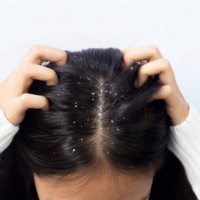 Dandruff